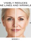 Before and after comparison of a woman’s face showing reduced fine lines and wrinkles after using ISREEN skincare product.
